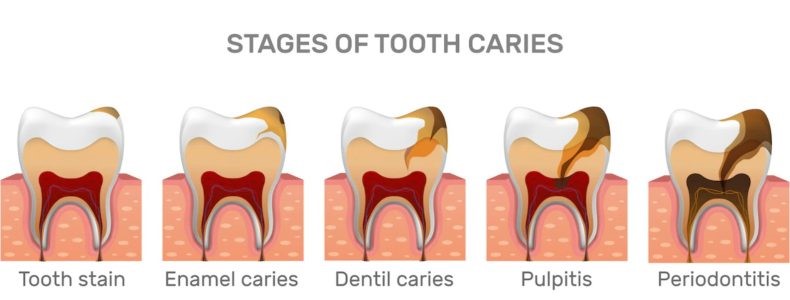 5stages