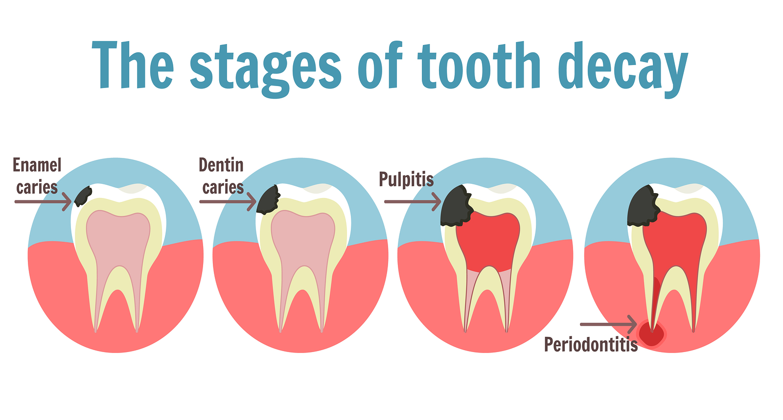 bigstock-The-Stages-Of-Tooth-Decay-Info-193925746