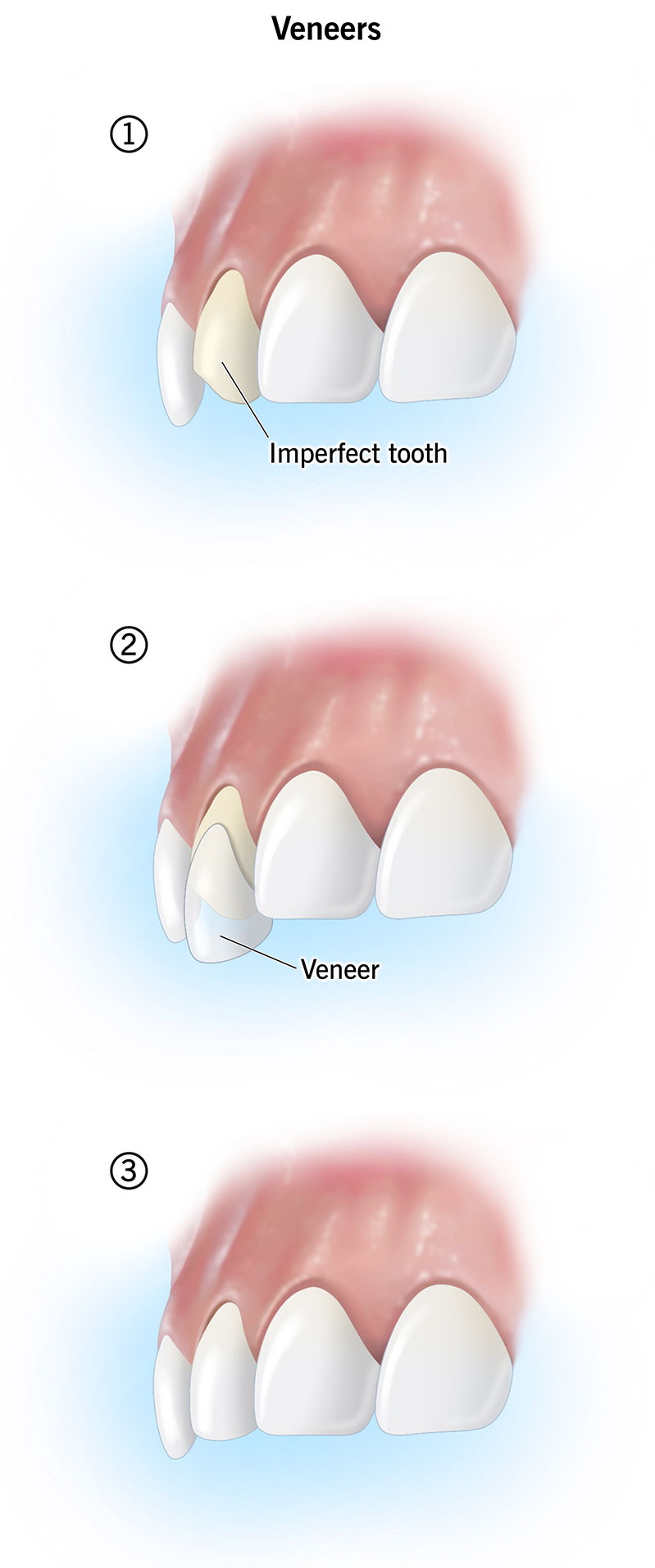 23522-dental-veneer