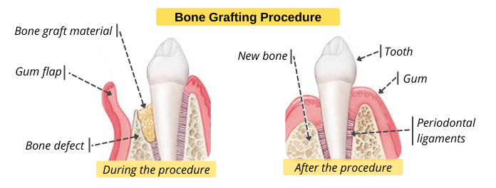 Bone-Grafting-for-the-Treatment-of-Periodontitis.png