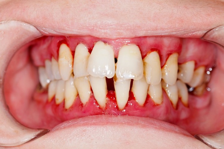 Mengenal-penyebab-dari-periodontitis.jpg