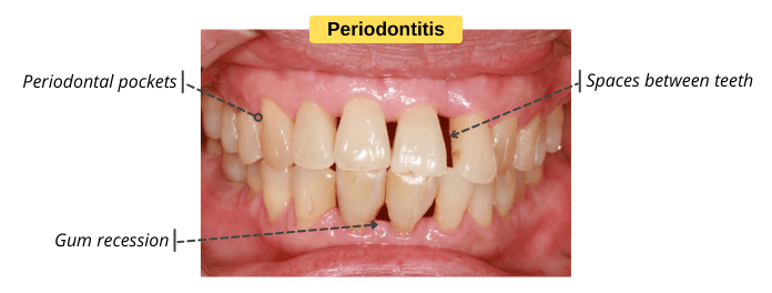 Signs-Symptoms-of-Periodontitis.png