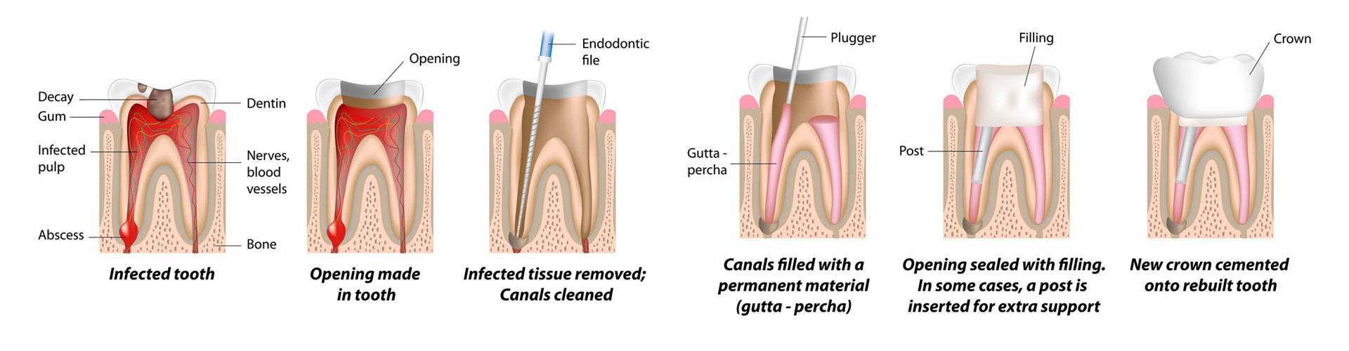 root-canal-process