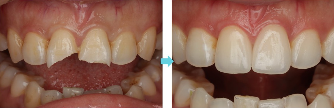 incisor