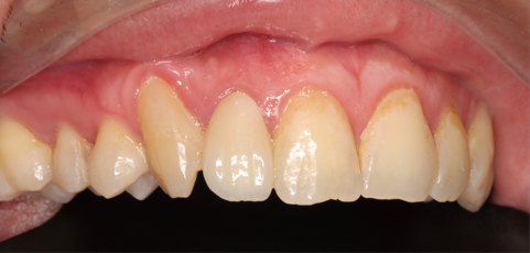 all-ceramic crown restoration1