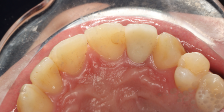 all-ceramic crown restoration12