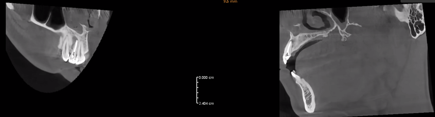 Follow-up ridiography