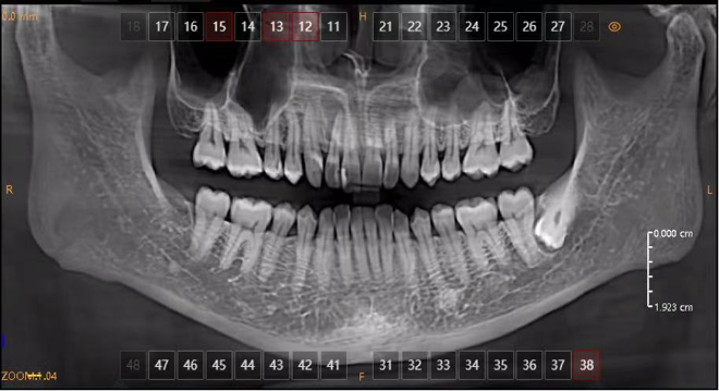 periapical cyst Panoramic radiograph