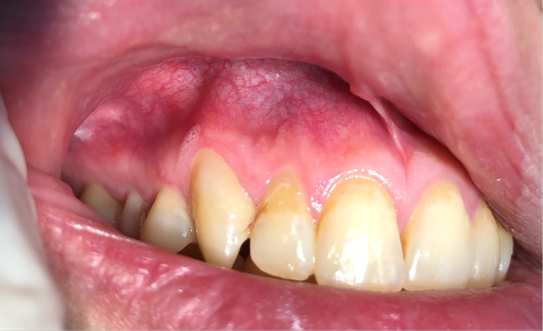 periapical cyst