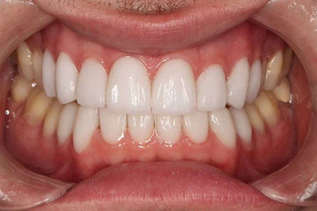 Ceramic Veneer Bonded2.jpg Ceramic Veneer Bonded2.jpg