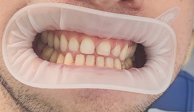 tooth preparation.jpg tooth preparation.jpg