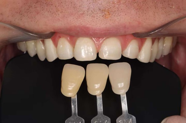 shade selection shade selection