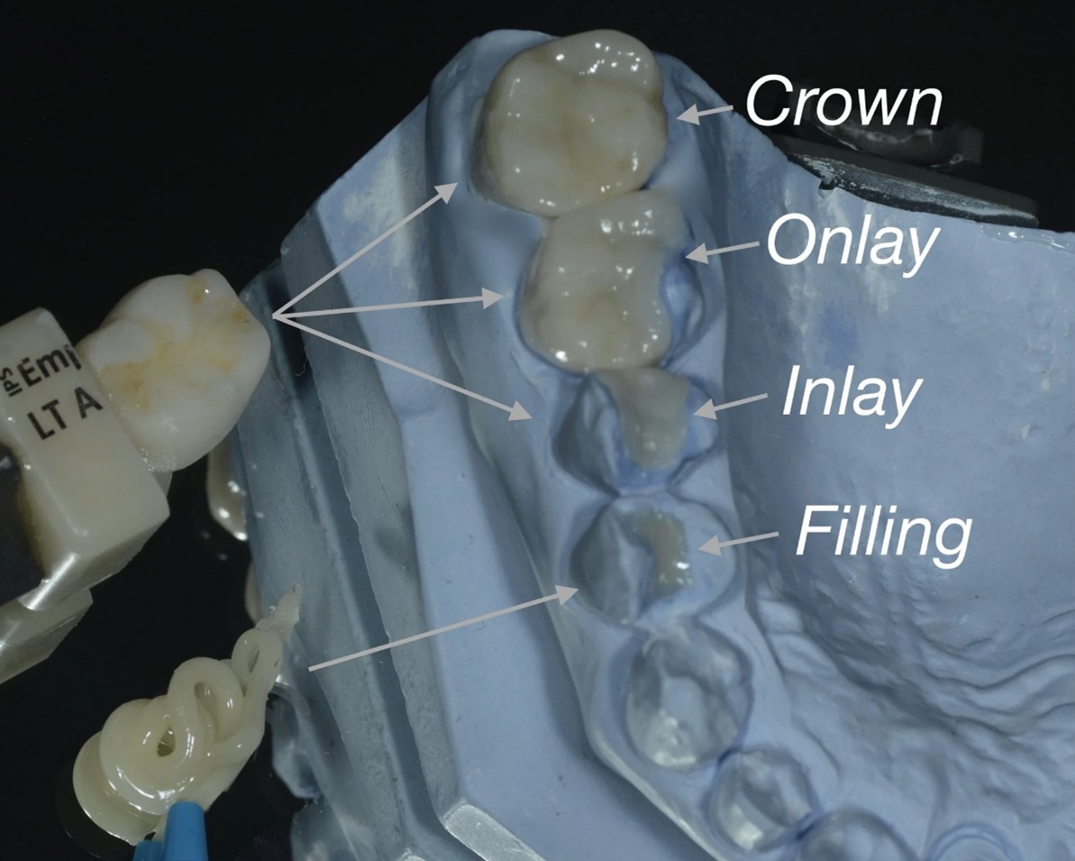 crown onlay inlay filling