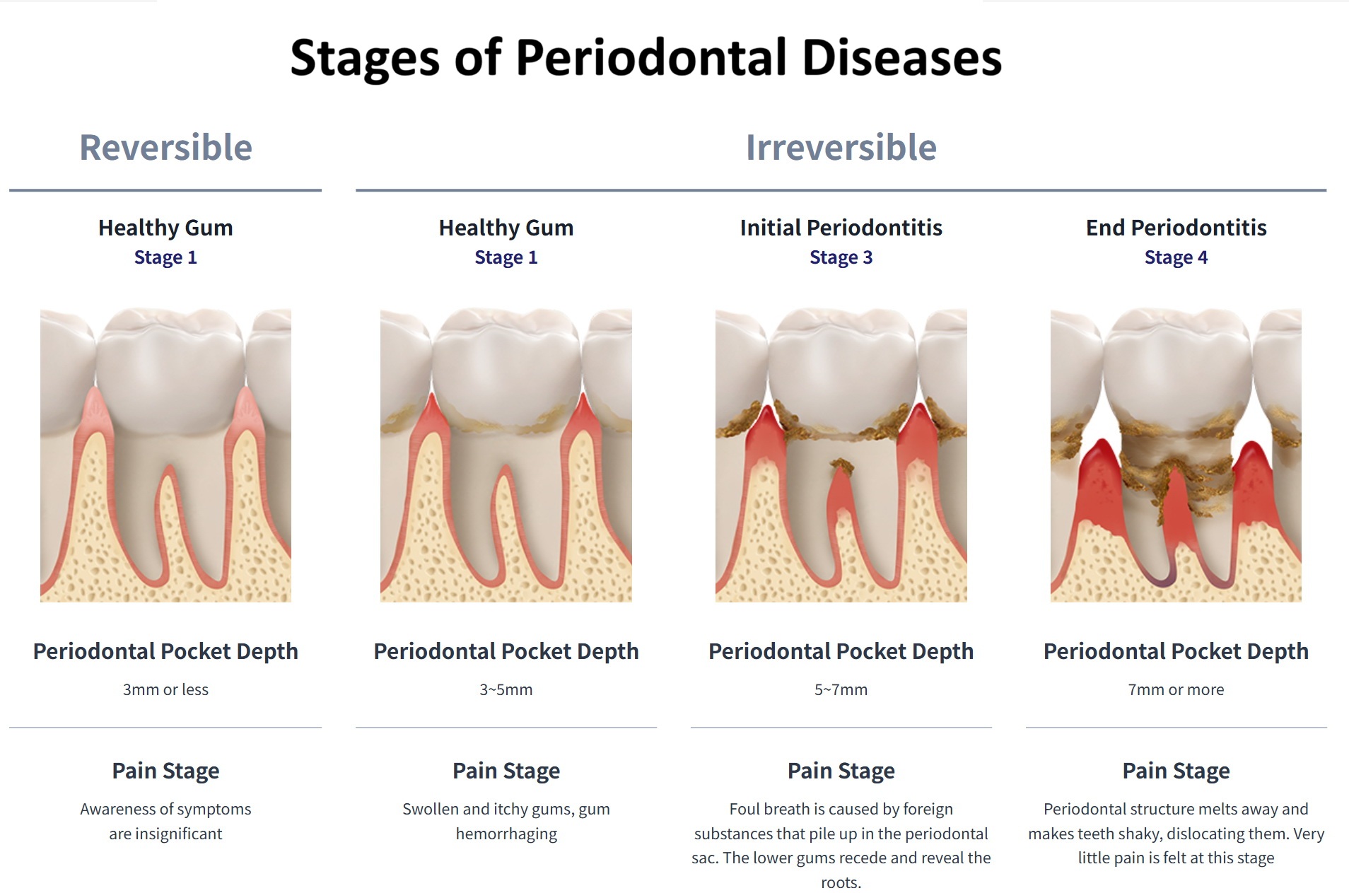 Stage of periodontal Diseases.jpg