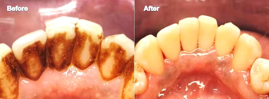 non-surgical-periodontal-treatment