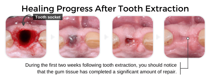 Healing Process After Tooth Extraction