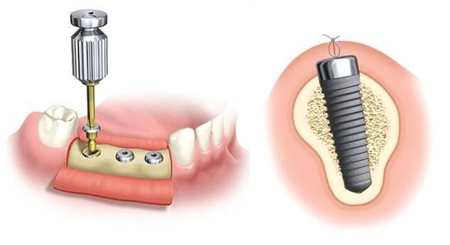vis-de-coverture-suba-dental-implantation-dentaire vis-de-coverture-suba-dental-implantation-dentaire