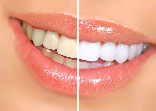 whitening whitening