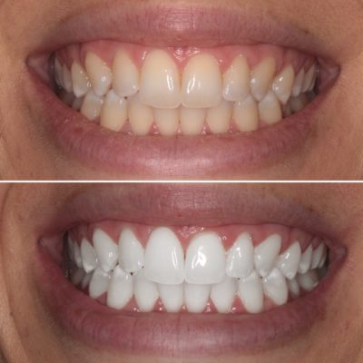 teeth whitening teeth whitening