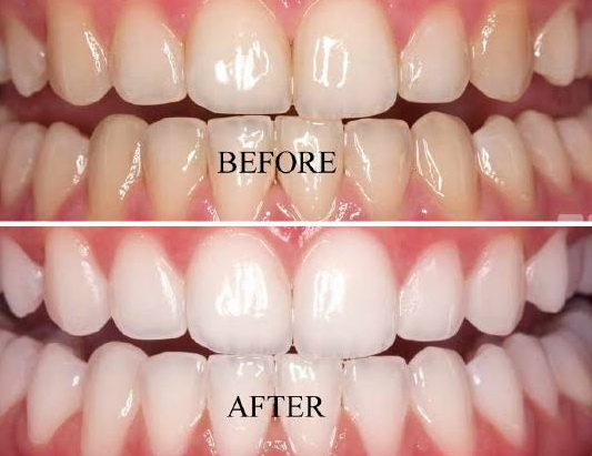 teeth whitening2 teeth whitening2