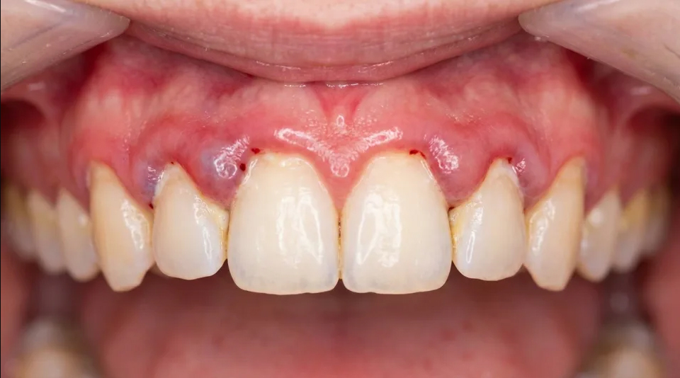 gingivaltitis gingivaltitis