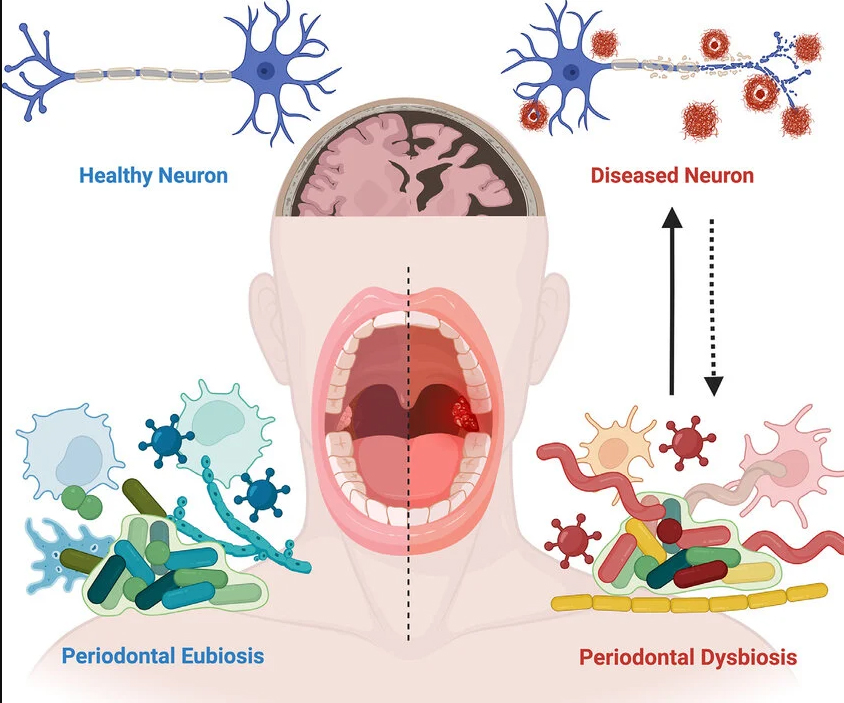 Three proposed pathways linking periodontal disease to brain pathology